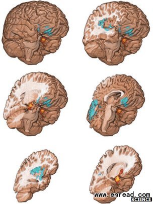 Red areas show parts of the brain more active in drug users. Blue regions are abnormally decreased in drug users.